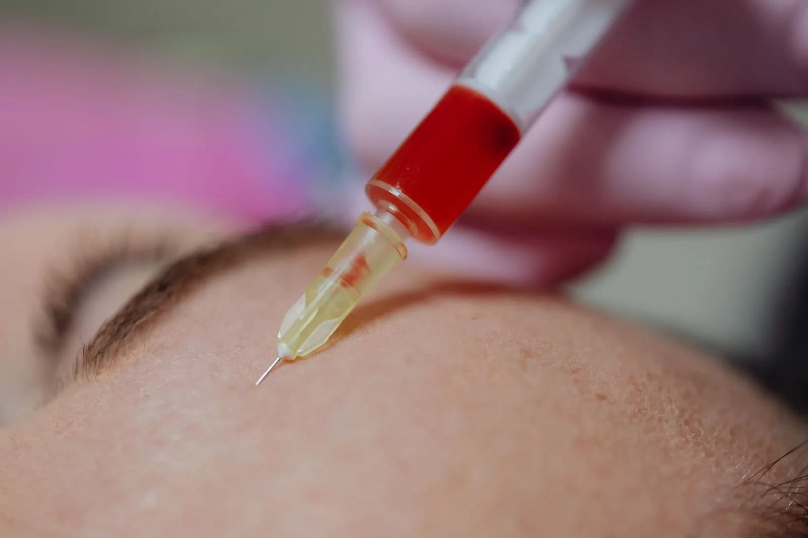 A clinical close-up of a cosmetic syringe, illustrating anti-wrinkle injections vs fillers cost in Malta
