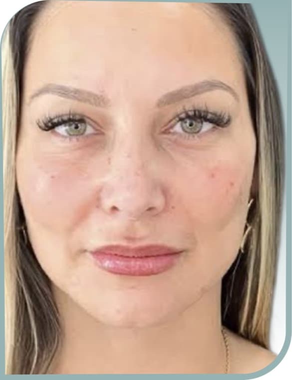 Refreshed under-eyes, After photo (result 6 of 6)