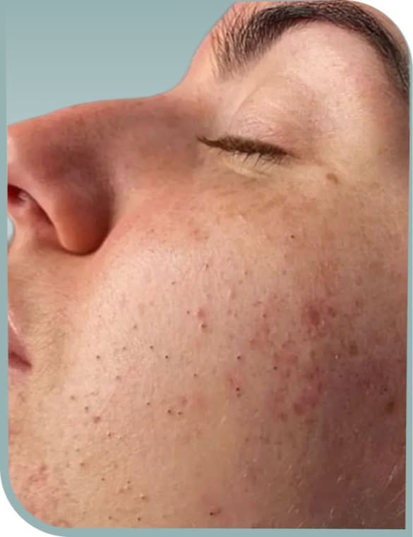 Clearer cheek skin, Before photo