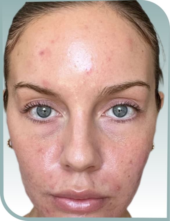 Calmer blemish-prone skin, Before photo