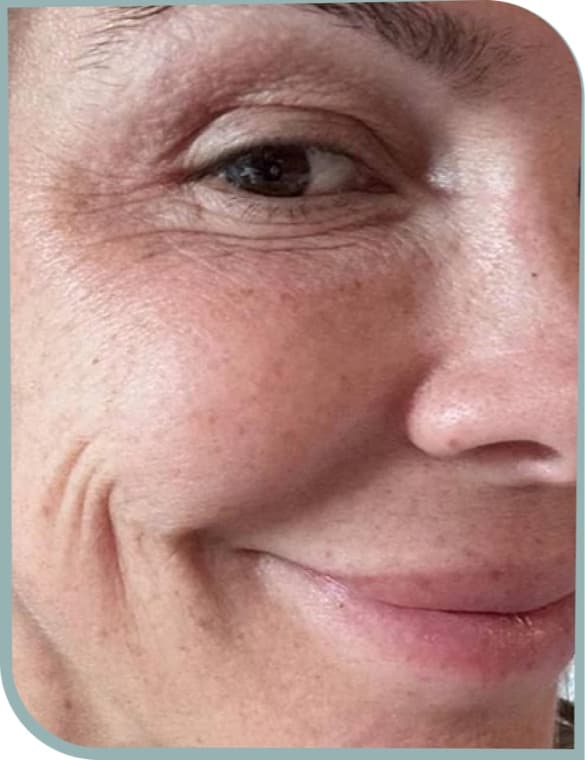 Softer cheek lines, Before photo (result 2 of 6)