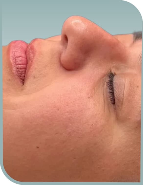 Smoother lip area, Before photo (result 7 of 10)