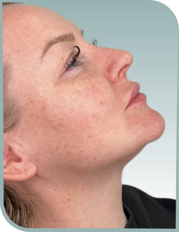 Even cheek tone, Before photo (result 4 of 6)