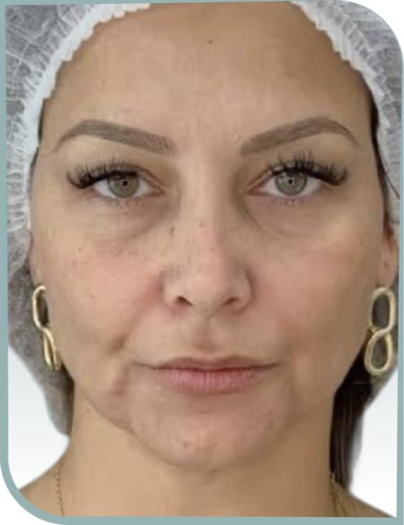 Refreshed under-eyes, Before photo (result 6 of 6)
