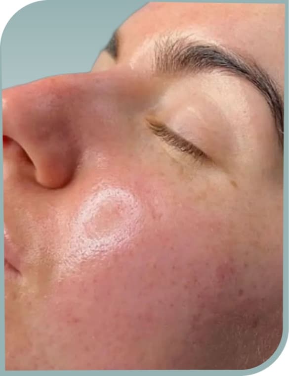 Clearer cheek skin, After photo (result 3 of 10)