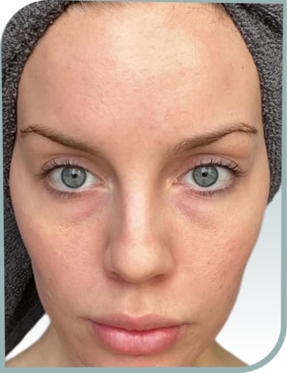 Calmer blemish-prone skin, After photo