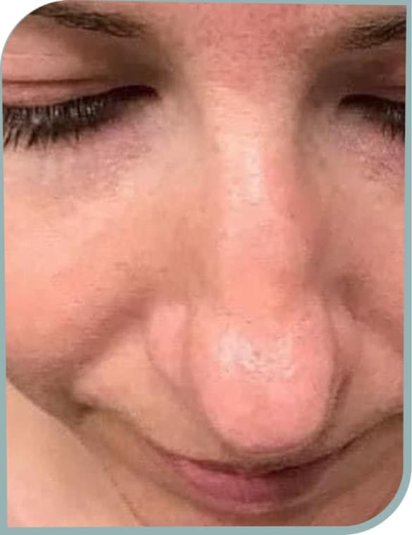 Refreshed central face, After photo (result 5 of 10)