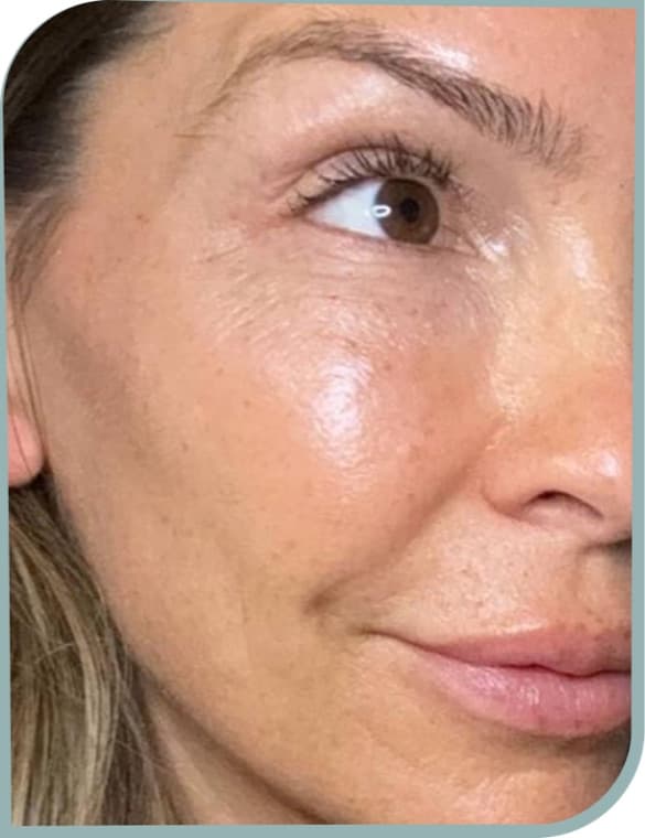Softer cheek lines, After photo (result 2 of 6)
