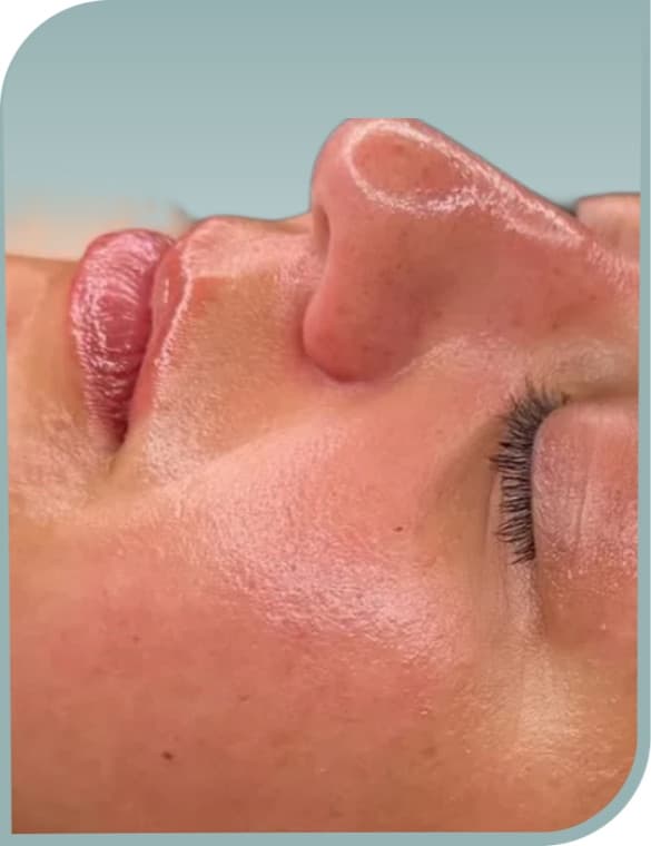 Smoother lip area, After photo (result 7 of 10)
