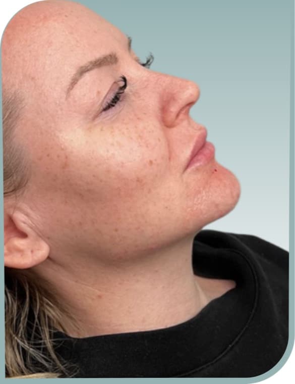 Even cheek tone, After photo (result 4 of 6)