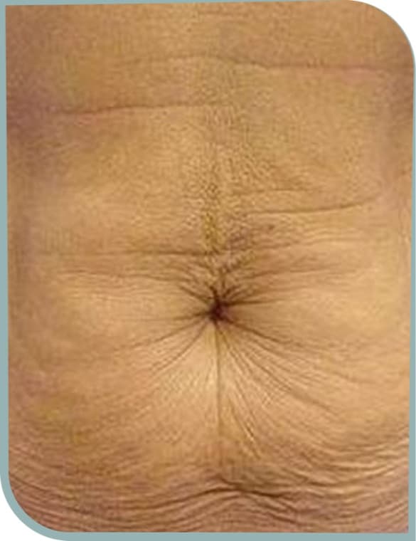 Crepey tummy skin, Before photo (result 6 of 10)