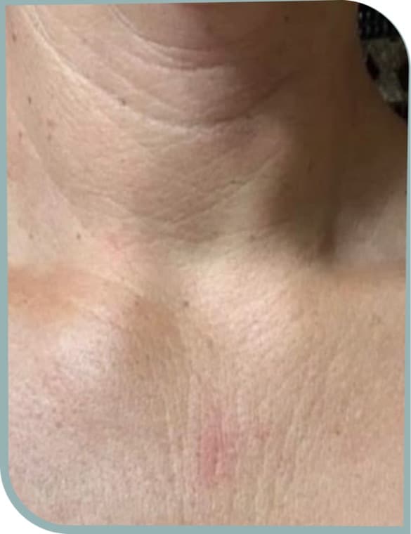 Neck lines, Before photo (result 10 of 10)