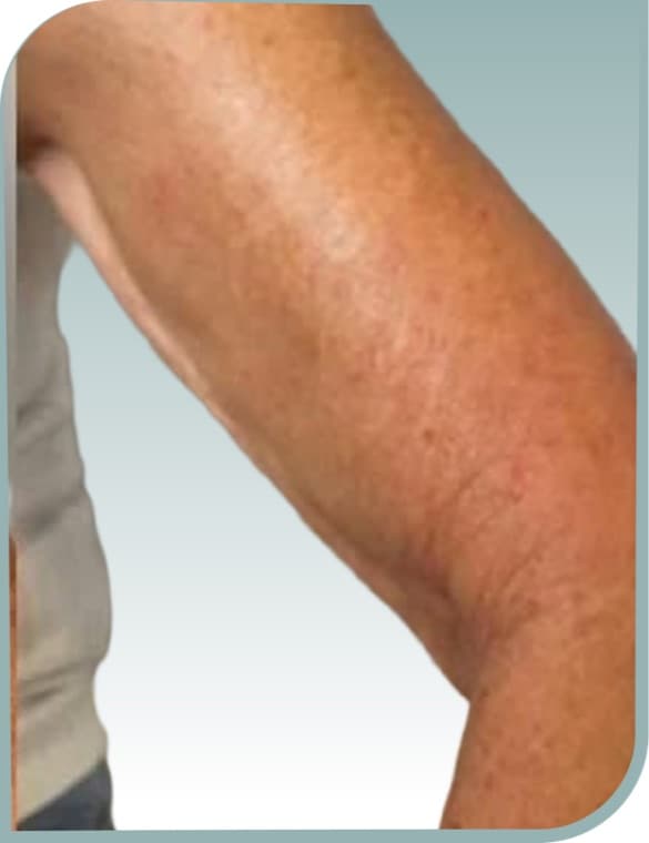 Crepey arm skin, After photo (result 1 of 10)