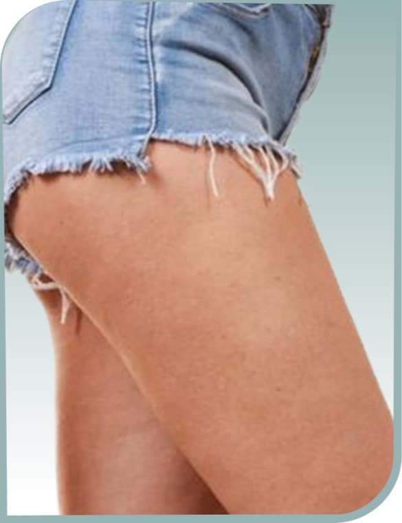 Thigh cellulite, After photo (result 2 of 10)