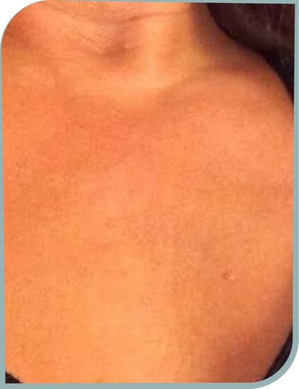 Chest crepiness, After photo (result 5 of 10)