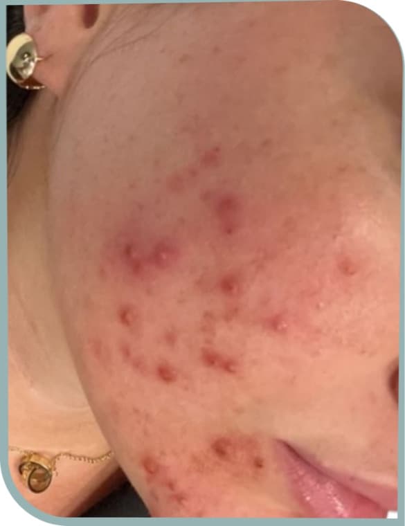 Inflamed acne, Before photo (result 1 of 10)