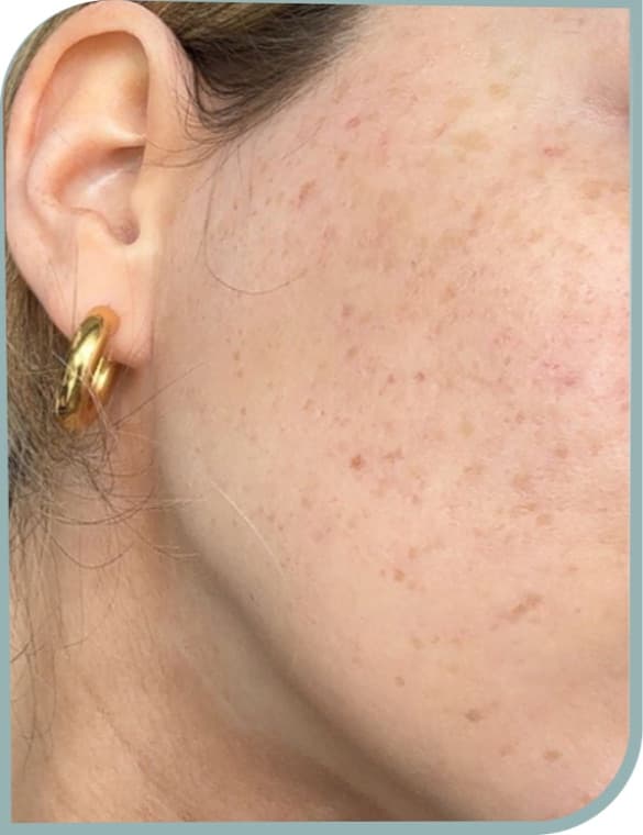 Inflamed acne, After photo (result 1 of 10)