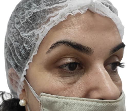 Before photo: Chemical Peels result at Carisma Aesthetics Malta
