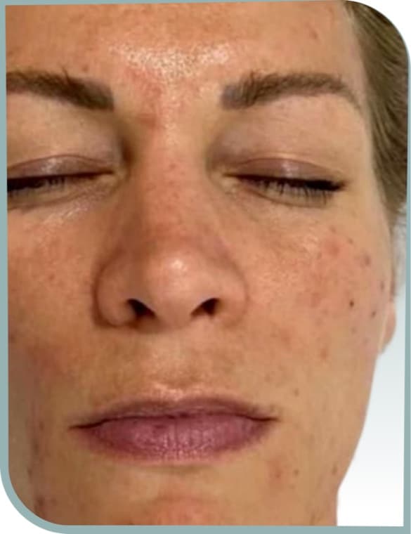 Pigmentation and dullness, Before photo (result 10 of 10)