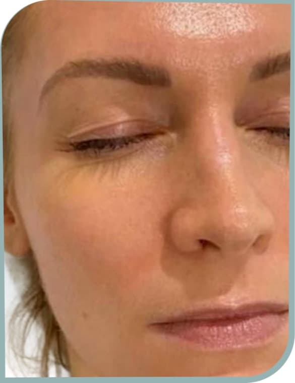 Pigmentation and dullness, After photo (result 10 of 10)