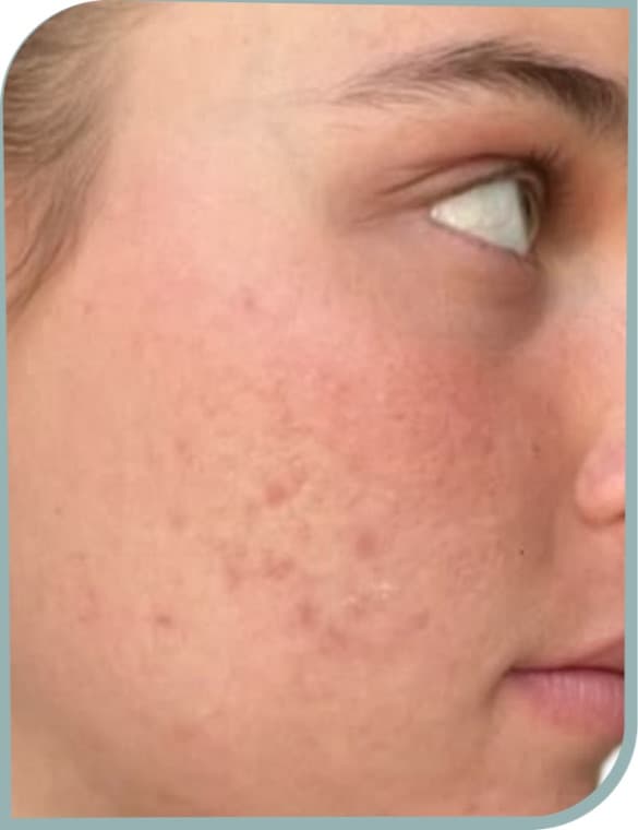 Acne and redness, After photo (result 2 of 10)