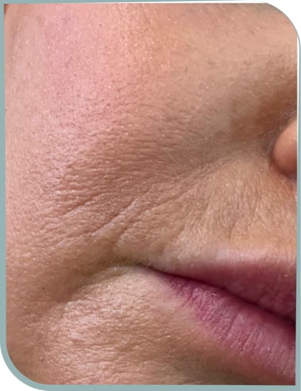 Fine lines and texture, Before photo (result 4 of 10)