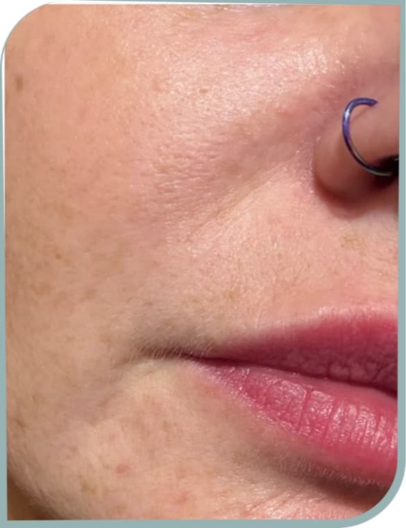 Fine lines and texture, After photo (result 4 of 10)