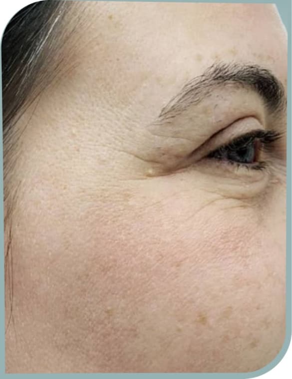 Eye area pigmentation, After photo (result 5 of 10)