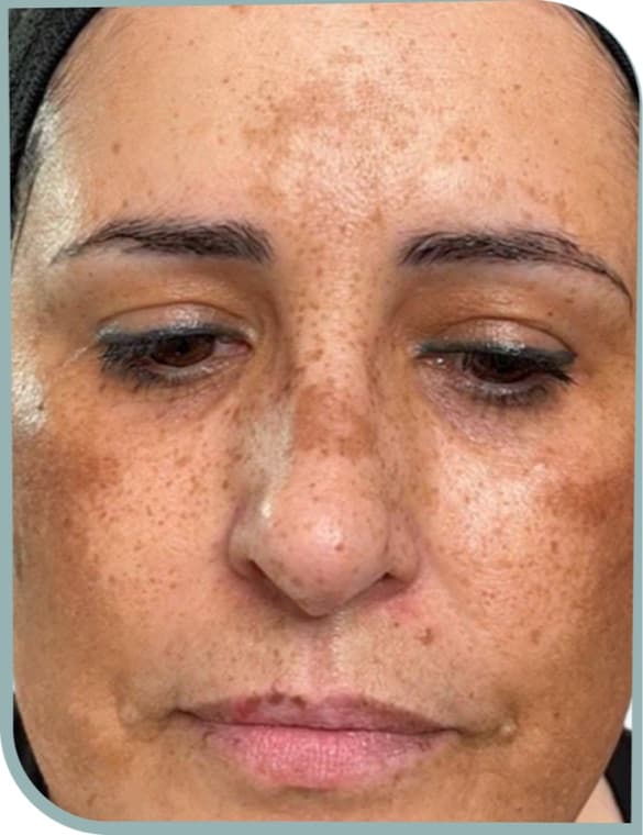 Facial melasma, Before photo (result 6 of 10)