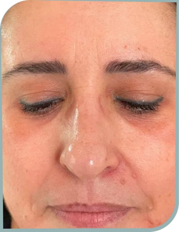 Facial melasma, After photo (result 6 of 10)