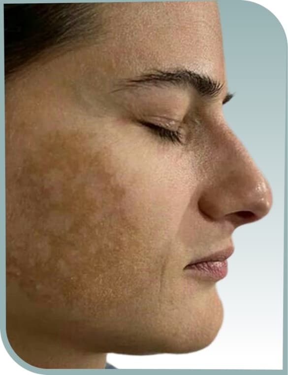 Cheek melasma, Before photo (result 8 of 10)