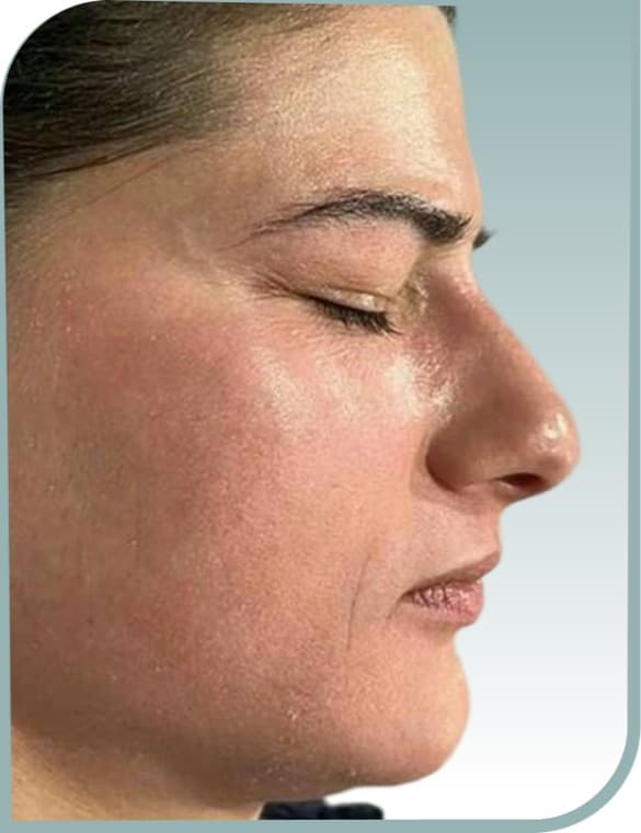 Cheek melasma, After photo (result 8 of 10)