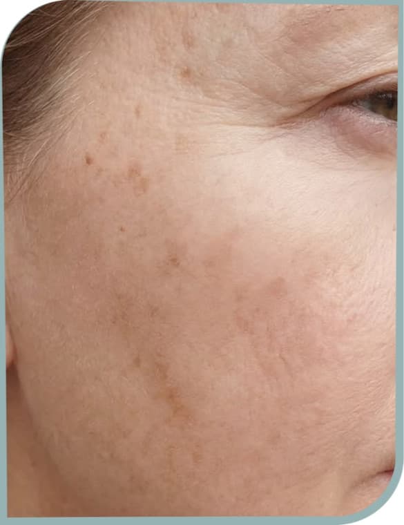 Sun spots, After photo (result 9 of 10)