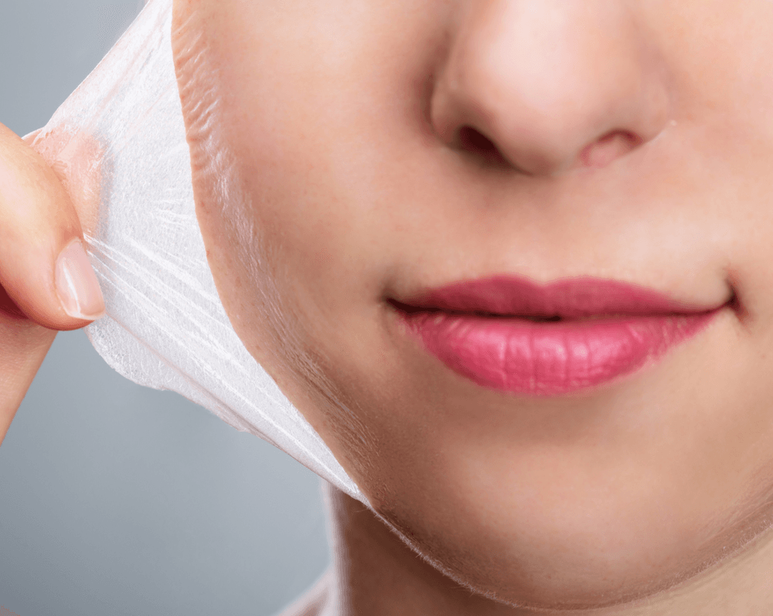 Chemical peel treatment at Carisma Aesthetics Malta