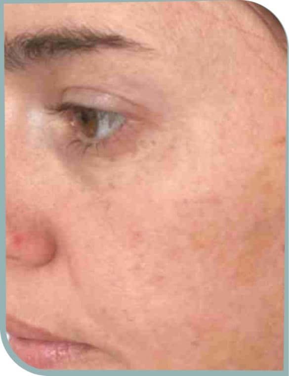 Uneven cheek tone, Before photo (result 1 of 10)