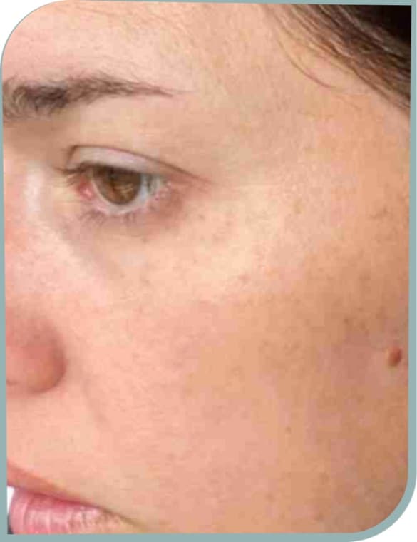 Uneven cheek tone, After photo (result 1 of 10)