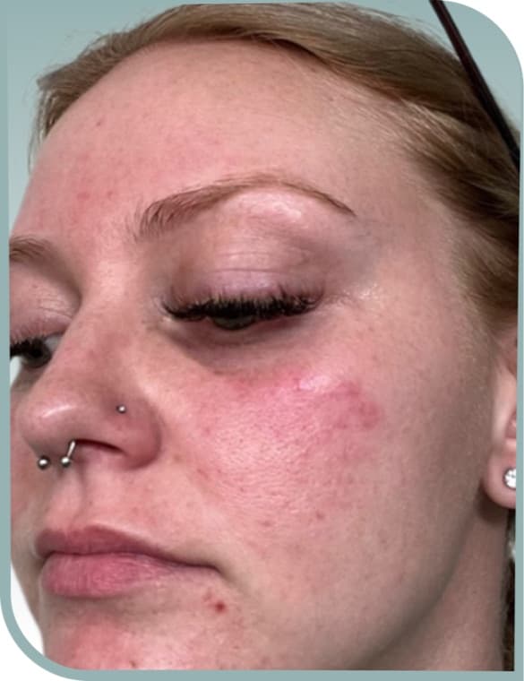 Cheek redness, Before photo (result 10 of 10)