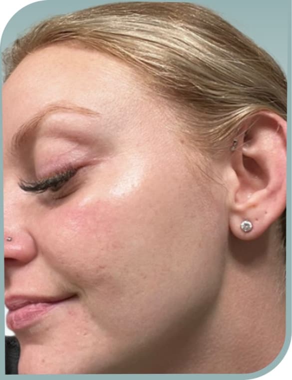 Cheek redness, After photo (result 10 of 10)