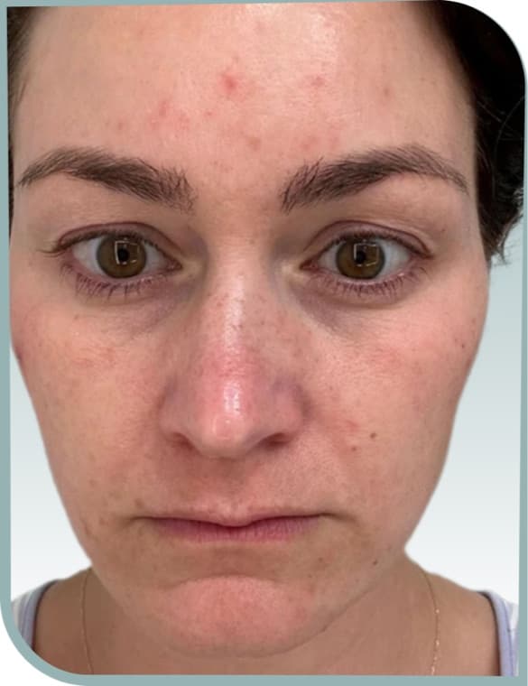 Skin quality, Before photo (result 2 of 10)