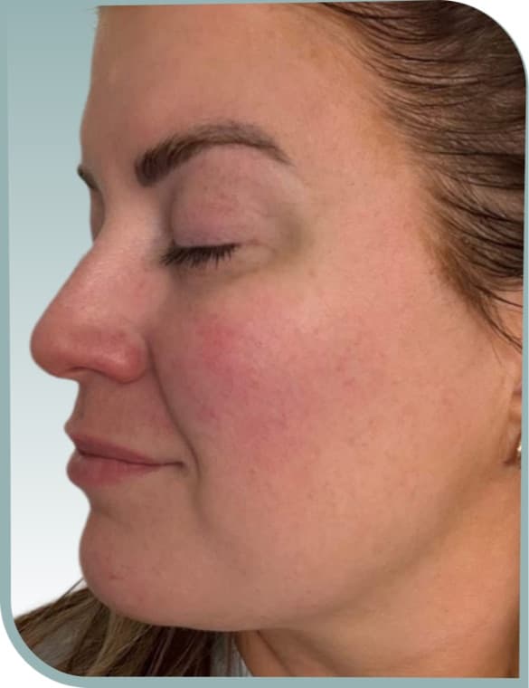 Cheek volume, Before photo (result 4 of 10)
