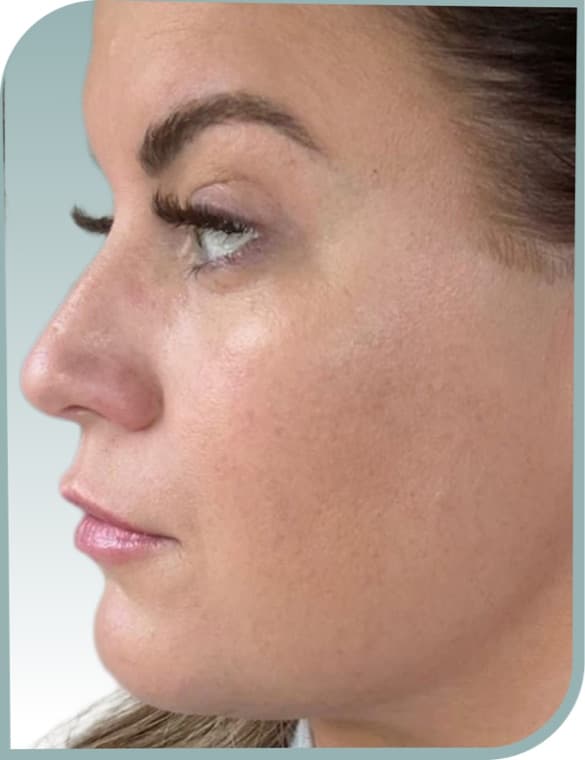 Cheek volume, After photo (result 4 of 10)