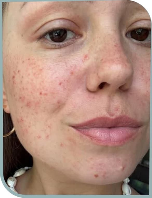 Cheek texture, Before photo (result 5 of 10)