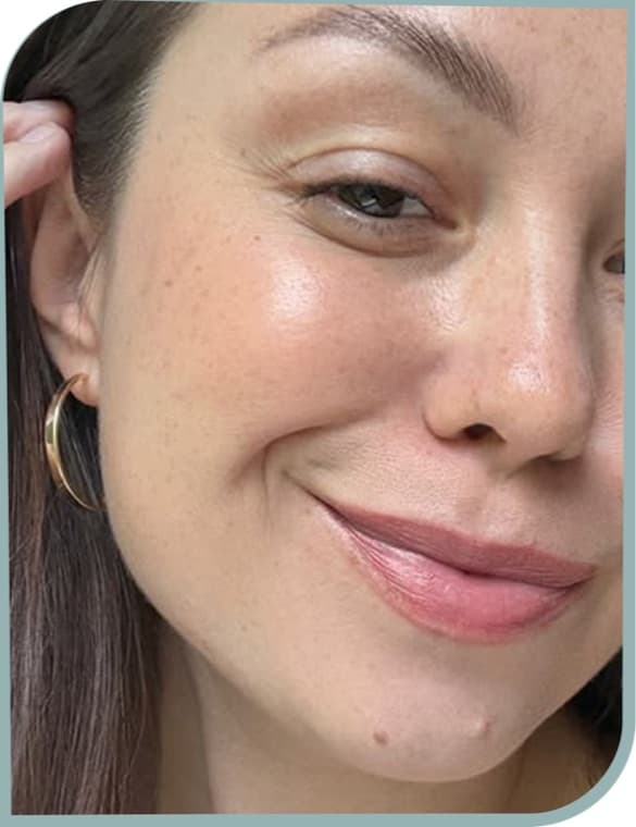 Cheek texture, After photo (result 5 of 10)