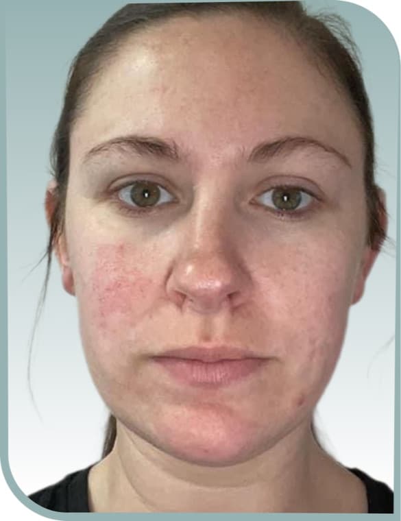 Facial redness, Before photo (result 6 of 10)