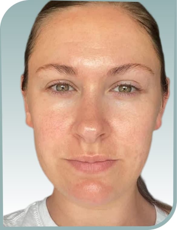 Facial redness, After photo (result 6 of 10)