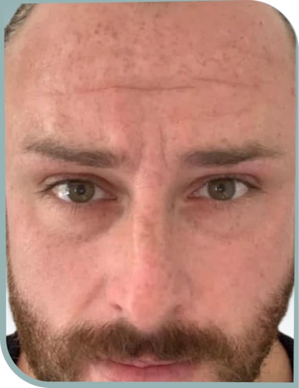 Forehead lines, Before photo (result 7 of 10)