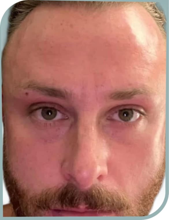 Forehead lines, After photo (result 7 of 10)