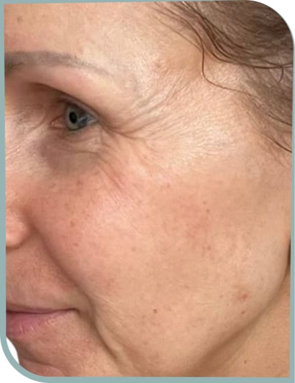 Under-eye lines, Before photo (result 8 of 10)