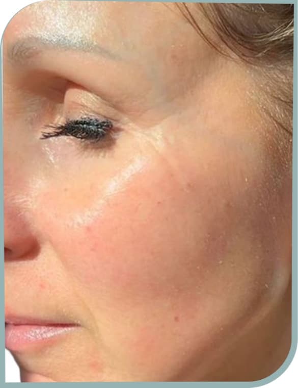 Under-eye lines, After photo (result 8 of 10)