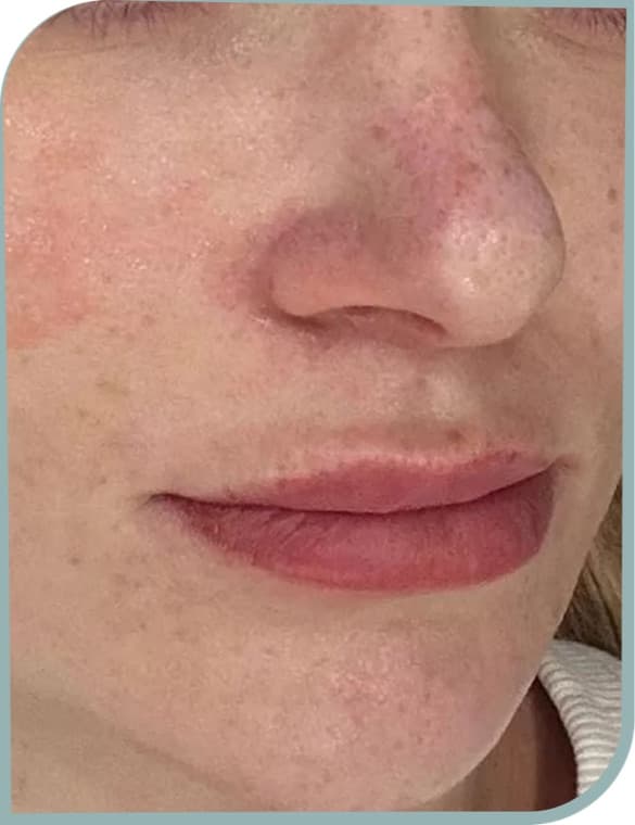 Cheek pores, After photo (result 9 of 10)